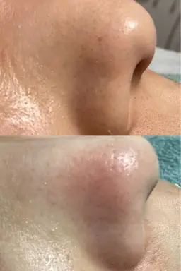 【ミニモ学割/話題の毛穴洗浄】メンズもOK!美白毛穴洗浄ペプチド美容液導入フェイシャル¥6900