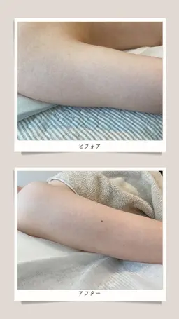 ひじ下（手指含/両腕） ※自己処理なしでお越しください.
