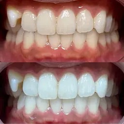 セルフホワイトニング🦷8分×2回照射(空きはリクエストからお問い合わせください)