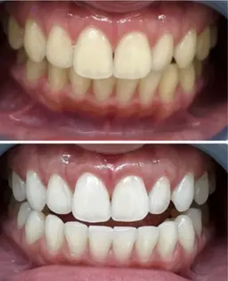 【初回限定⭐︎特別価格】超集中ハイパワーコース◎しっかり結果をだしたい方!(15分照射×2)