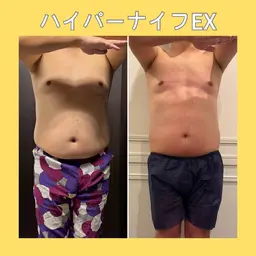 【モニター募集❣️】男性・女性OK👌🏻気になるお腹・腰肉・埋もれた肩甲骨に❤️上半身痩身モニター/ハイパーナイフEX