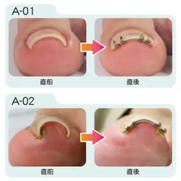 【巻き爪矯正1本(クリアジェル仕上げ)】フットバス、丁寧ケア、矯正装具込み