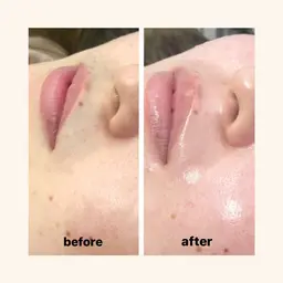 【お肌ツルツル】フェイシャルWAX脱毛