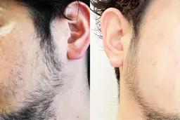 美肌脱毛✨ヒゲ脱毛🥸