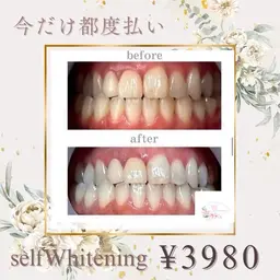 【効果絶大超ロング照射⭐️】1回限定ご利用可能クーポン🎶セルフホワイトニング60分¥7980→¥3980