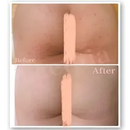 【美尻の為の最上級スペシャルケア✨】脱毛+代謝サポートハーブピーリング+ハイドロジェリー+専用LED