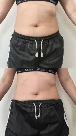 ２回目以降の方【10名限定🔥】集中痩身キャビコース｜45分1部位 通常1回6,000円が3,000円の10回コース！！