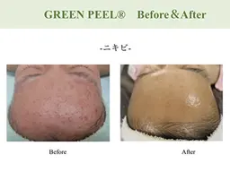 世界中で大人気グリーンピール