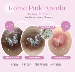 🩷ローマピンク🩷　ニップル　半額キャンペーン　無料カウンセリング予約！当日施術も可能です！132000円