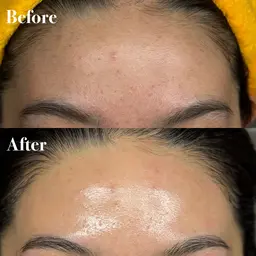 フェイシャルwax脱毛　クリニックレベルエクソソーム導入付き