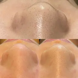 🌱初回限定。毛穴エクストラクション⭐️いちご鼻👃🍓【速攻実感✨毛穴改善】⚠️お鼻と1パーツお選びいただけます。
