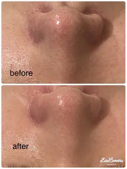 毛穴ピーリングでつるんと小鼻美人✨