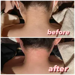 【シュガーリング＋光脱毛】うなじ脱毛🧡スッキリうしろ姿も美人に✨