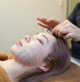 👰‍♀️リフトアップ美容鍼👰‍♀️【AI姿勢診断＋美容鍼】SNSで話題💫