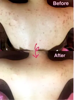 背中ニキビ撃退コース