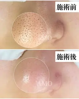 毛穴美人コース