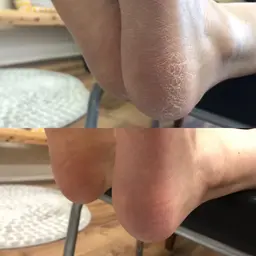 《フットケア》弱酸性化粧品を使ったかかと角質除去✨¥6600→¥5500保湿をしながら除去していくので仕上がりがつるつる