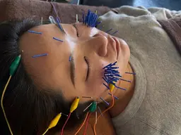 【12月 キャンペーン 残り5名】プレミアム美容鍼