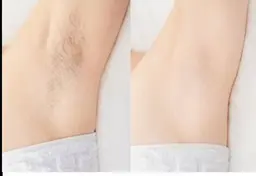 両ワキ脱毛1回