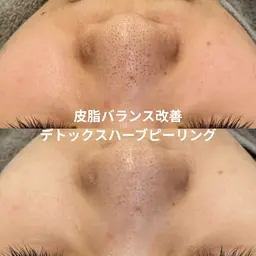 【平日限定】ハーブピーリング《顔》ニキビ跡・毛穴・赤み特化