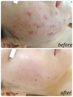 ＼ニキビ・毛穴に特化／！！次世代ハーブピーリング！！剥離もなくてつづけやすい！