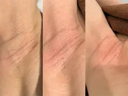 【脱毛全メニュー20%off】ホットペッパークチコミ5.0★【レディース全身フルケア】顔・Vio込！最新マシンで最短卒業