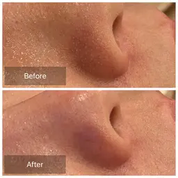 美脳小顔矯正&ハイドラフェイシャル毛穴ケア