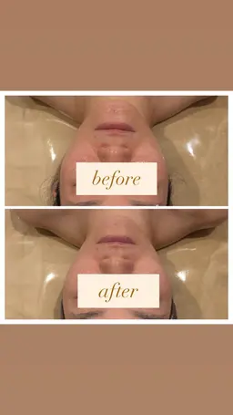 【𝐕𝐚𝐥𝐞𝐧𝐭𝐢𝐧𝐞 𝐦𝐞𝐧𝐮🍫2/1~2/28】 小顔EX×小顔コルギ×毛穴洗浄