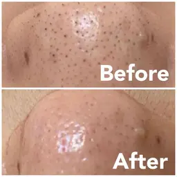 《小鼻》ハイドラ🩵いちご鼻／鼻の黒ずみ角質撃退👋【メンズもok】