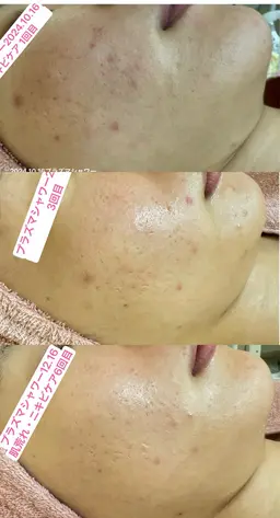 【❣️ミニモ特別価格❣️】長年の肌荒れでも諦めないで❗️肌荒れ・素早く改善&リフレッシュ60​〜​70分