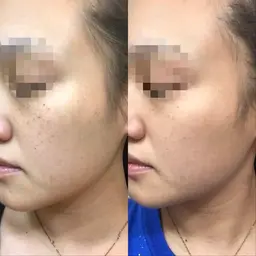 【シミにお悩みの方へ】光フェイシャルすっぴん来店でお値打ち