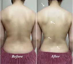 背中全体 👙 REVIハーブピーリング《陶肌トリートメント》 / 痩身効果大！背中荒れ改善・ブライダルにも◎