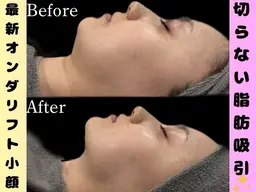 【オンダリフト速攻小顔】二重顎/口横ぽにょに効く‼️再来メニューでもお得に✨Google口コミ必須⚠️