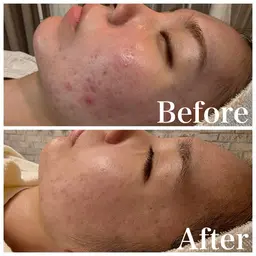 【open記念|3月限定】ハーブピーリング剥離あり