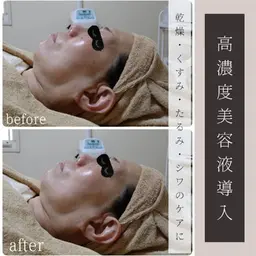 【高濃度美容液導入+小顔EMS】潤いハリツヤ肌へ