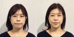 たるみ・しわ＋ストレートネック/姿勢改善