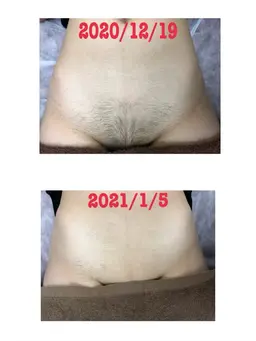 【満足度◎✨】VIO脱毛2回🌸シェービング代無料✨痛みが少ないのに1回でもスルスル抜ける劇的な効果💓