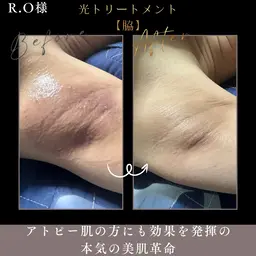 限定公開❣️韓国アイドルのような陶肌になりたい人必見‼️早い者勝ち🙌光トリートメントのモデルを部位別に募集✨