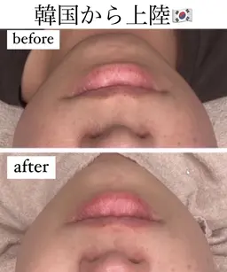 【毛穴洗浄+無針水光注入】《効果抜群》脂肪なくす！レモンボトル🍋たるみ/小顔に効果抜群☆