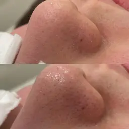 [毛穴汚れ気になる方]毛穴洗浄🌿