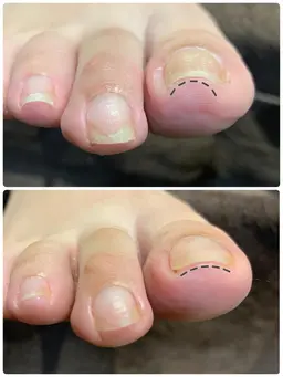 【 巻き爪ケア 】