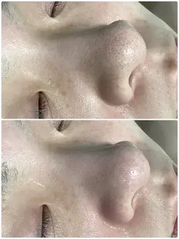 毛穴洗浄＋ハーブピーリング＋光フォト