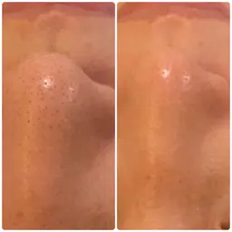 ★ハイドロスプラッシュ毛穴洗浄コース★