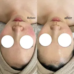 韓国式ピーリング