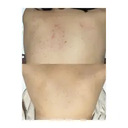 ミニモ学割🍁【12月学生限定脱毛パック】🍁全身脱毛+ぷる肌フェイシャル