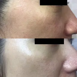 光フェイシャル+エレクトロポレーション