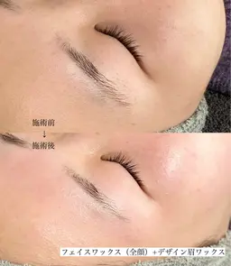 【全員】フェイスワックス(全顔)+美眉ワックス+シートマスク(保湿)