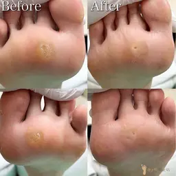 【足裏タコケア】足裏にできたゴワゴワ🌀角質もスベスベの足裏に✨是非お試しください💁‍♀️