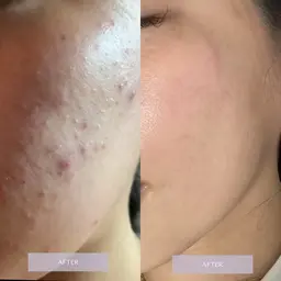 【平日のみ】韓国式🇰🇷剥離ありハーブピーリング🌿「毛穴洗浄付き」