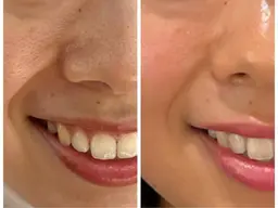 毛穴除去(毛穴洗浄)フェイシャルエステ